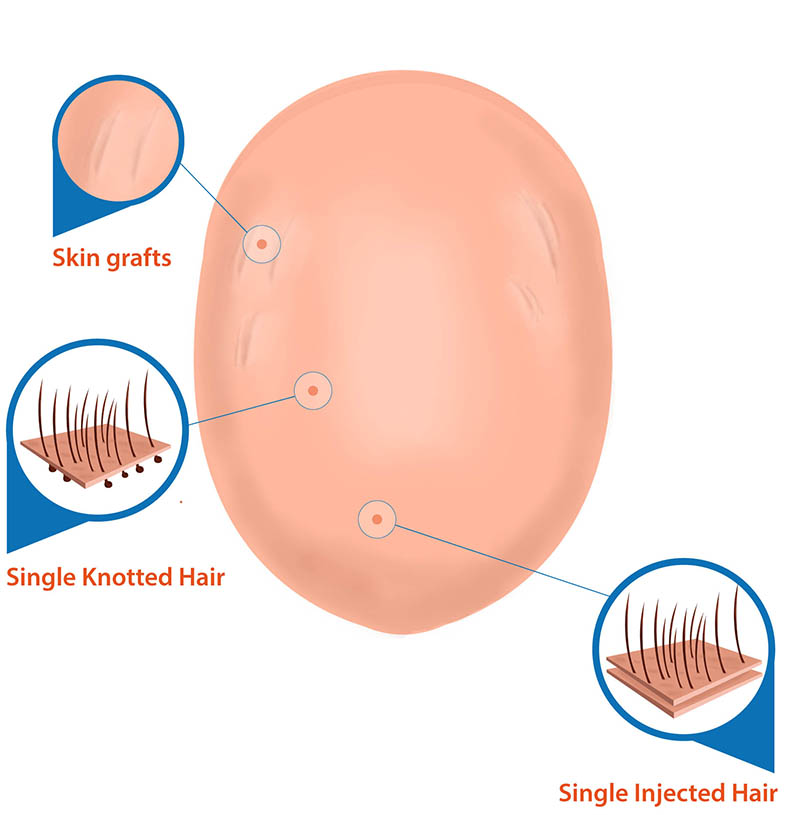 02-skin-grafts-final.jpg